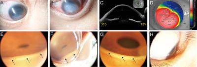 Case Report: Getting a Peek at the Angle of a Patient with Severe Keratoconus